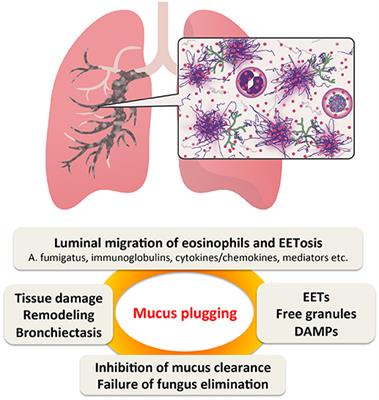 Allergic Bronchopulmonary Aspergillosis–A Luminal Hypereosinophilic Disease With Extracellular Trap Cell Death